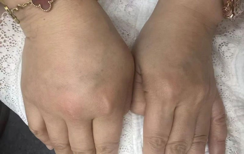 氧星壹号家用高压氧舱氧疗实例