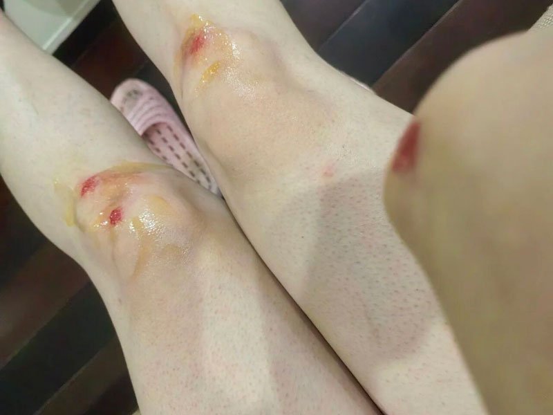 肿胀快速消退!实拍每日膝盖变化，看见高压氧的修复力量