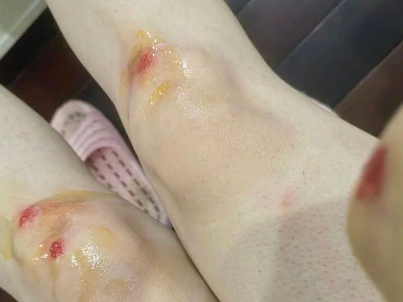 肿胀快速消退!实拍每日膝盖变化,看见高压氧的修复力量