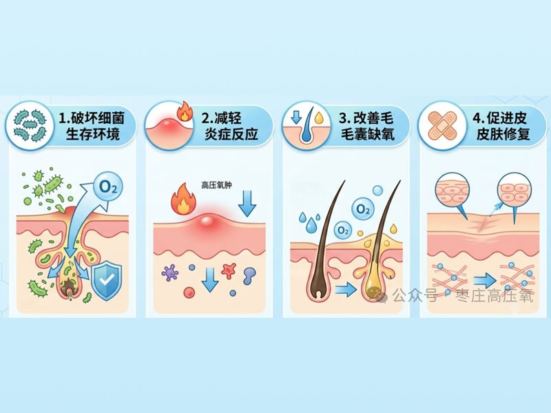 高压氧与寻常痤疮
